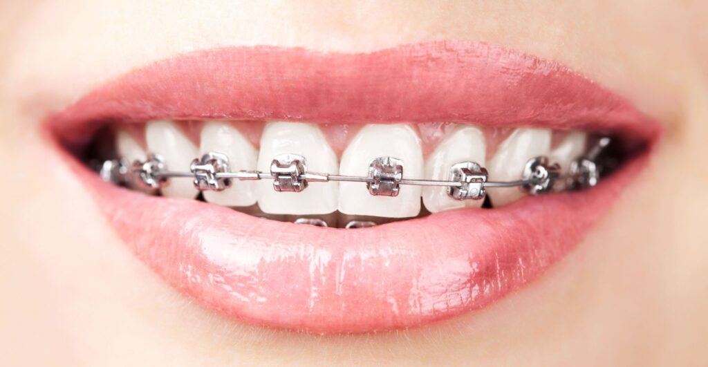 Braces