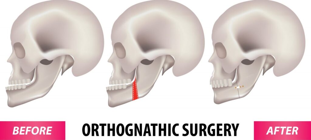 Orthognathic Surgery