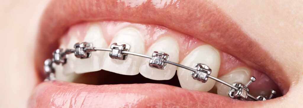 Orthodontic Treatment