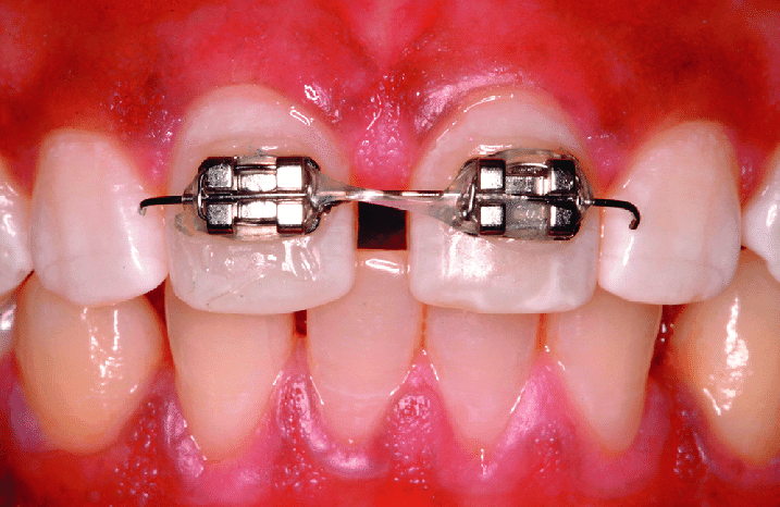 early orthodontic treatment